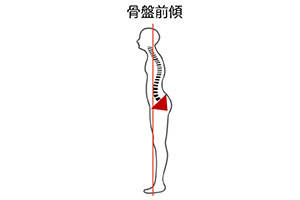 骨盤前傾