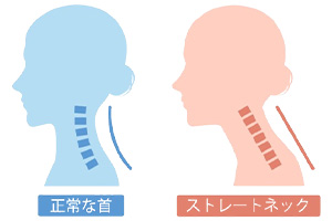 ストレートネック