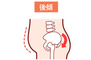 骨盤後継タイプ