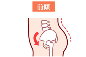 骨盤前傾タイプ