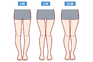 O脚の種類